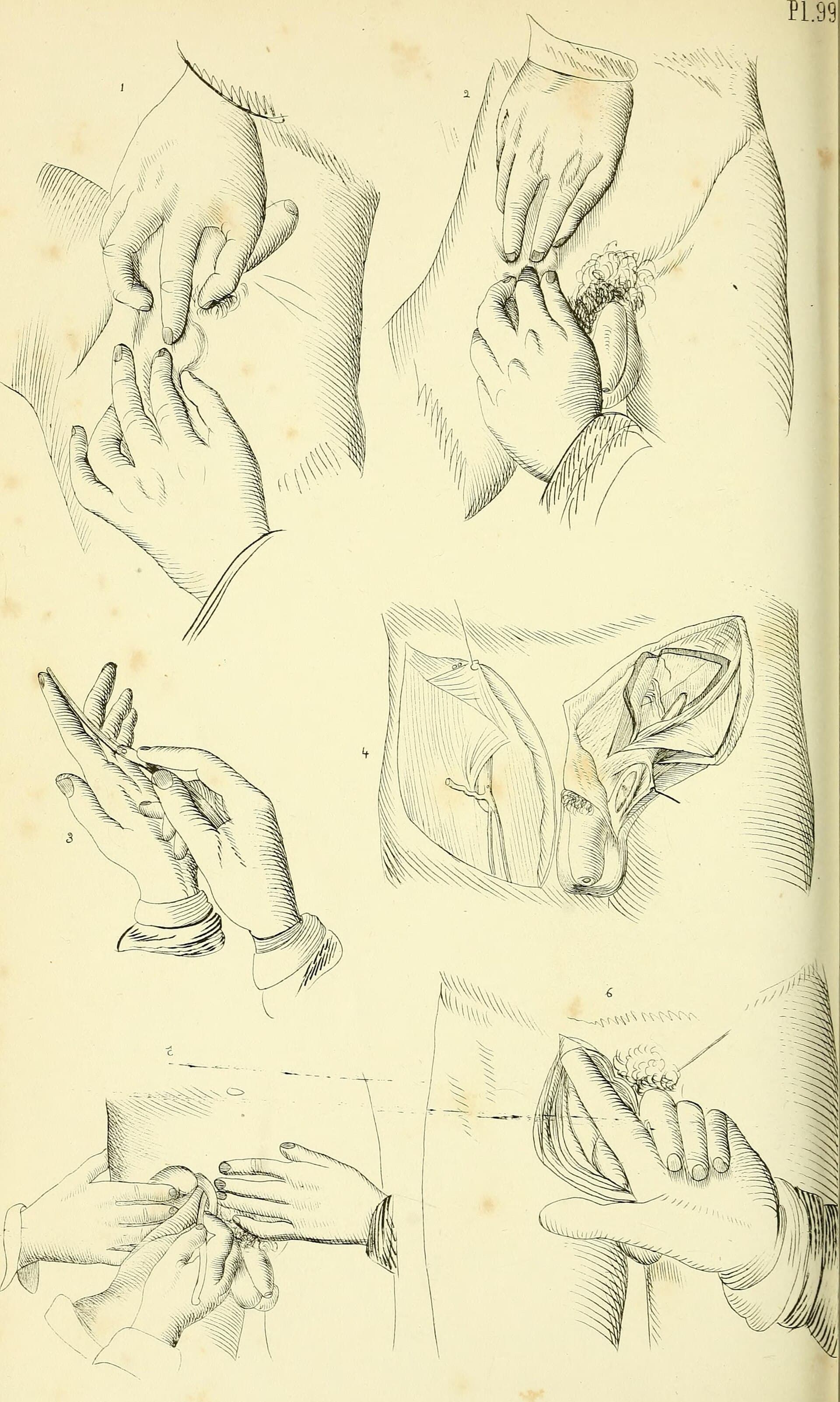 Lámina de 1852 con las manos de un cirujano durante una sutura
